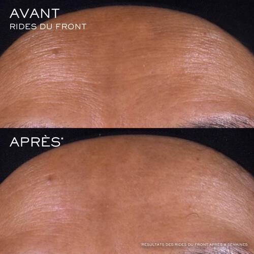 Comparaison avant/apres d'un front, montrant une reduction des rides. Effet visible apres traitement.